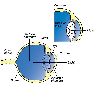 How Cataracts Effects Dogs' Eyes