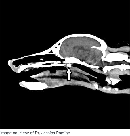Saggital view of CT scan image of nasal foreign body