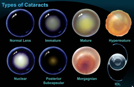 Types of Cataracts in Dogs